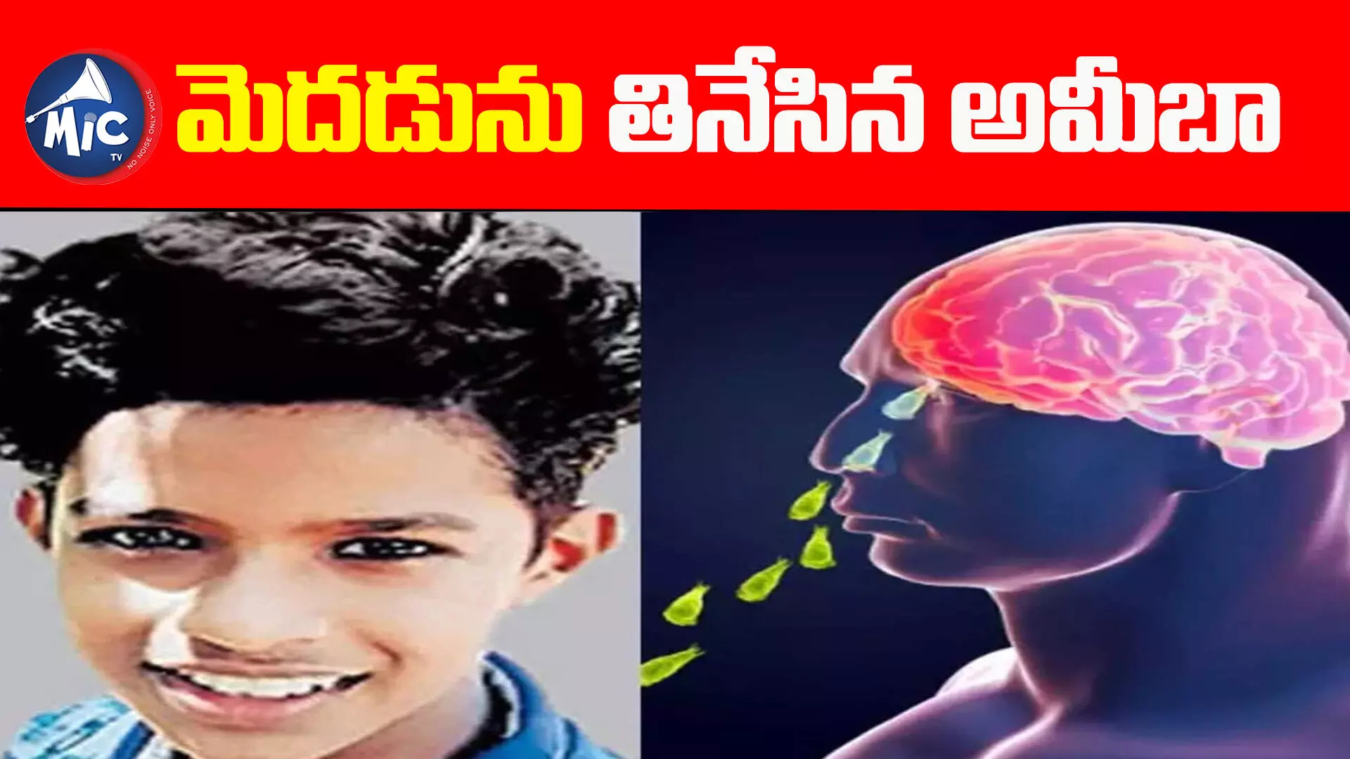 ముక్కులోంచి వెళ్ళి మెదడును తినేసిన అమీబా