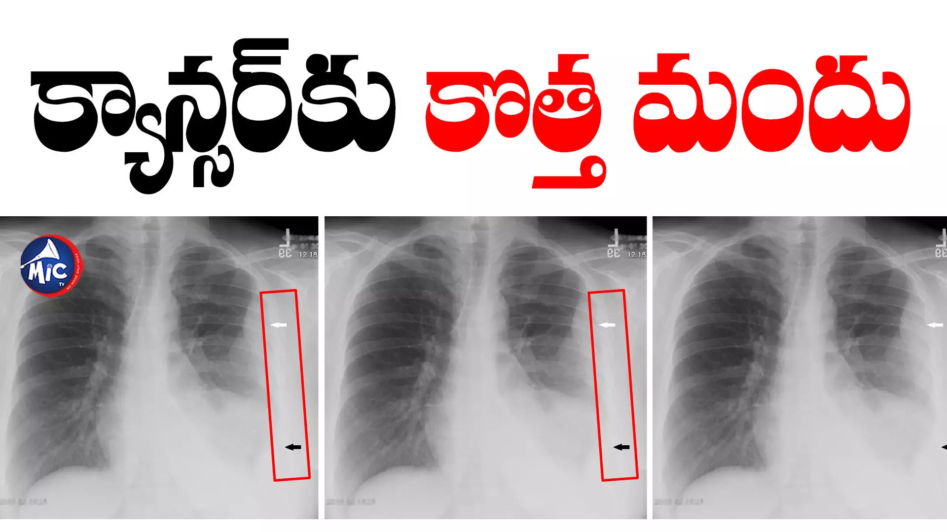 ADI PEG20 : గుడ్ న్యూస్.. క్యాన్సర్⁬కు కొత్త మందు కనిపెట్టిన సైంటిస్టులు